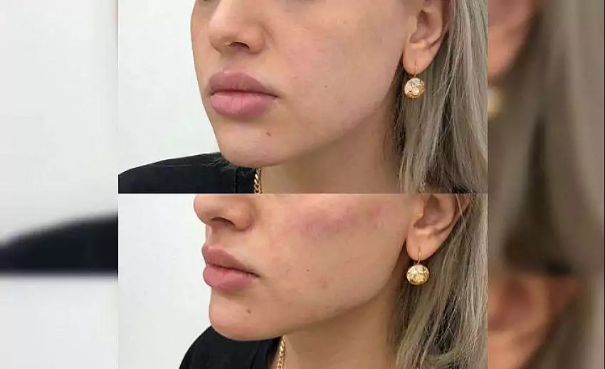 jawline dolgusu